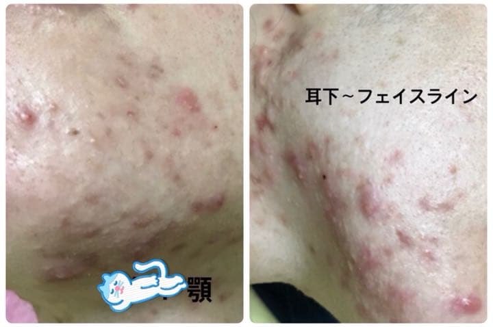 バイオプトロン2 美品　10万円大幅値下げ